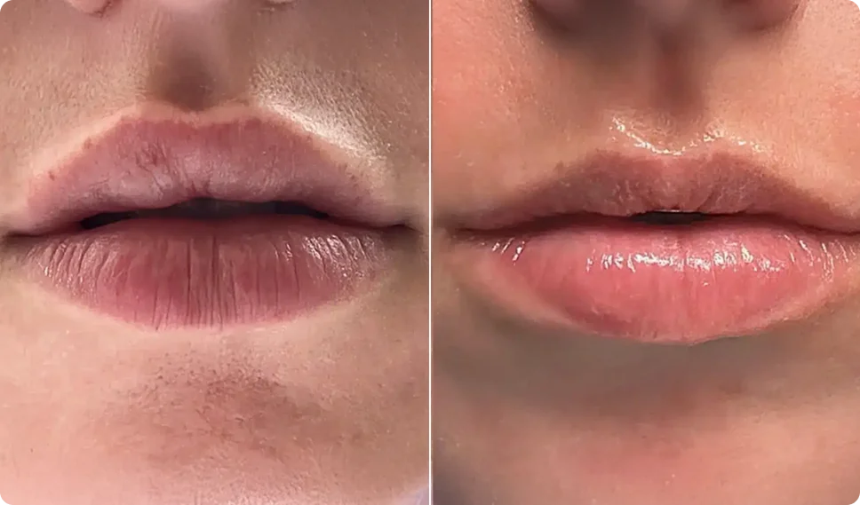 Filler Disolve Comparison