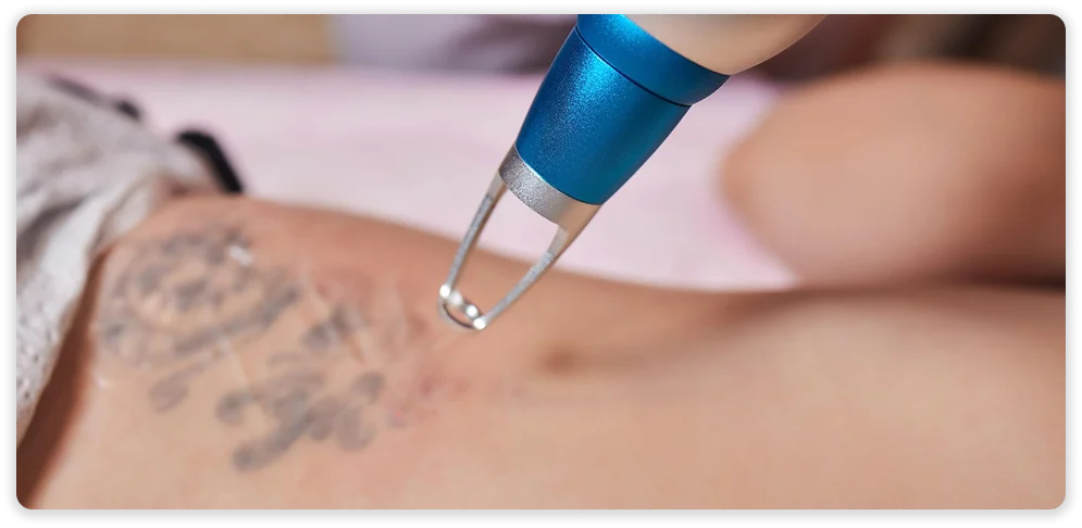 LaserTatto1