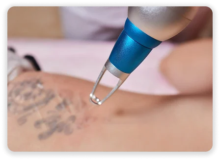 LaserTattoo2