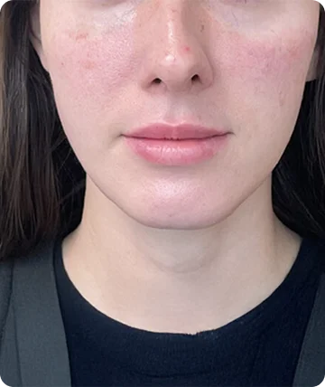 Facial After