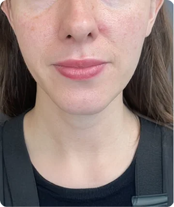 Facial Before